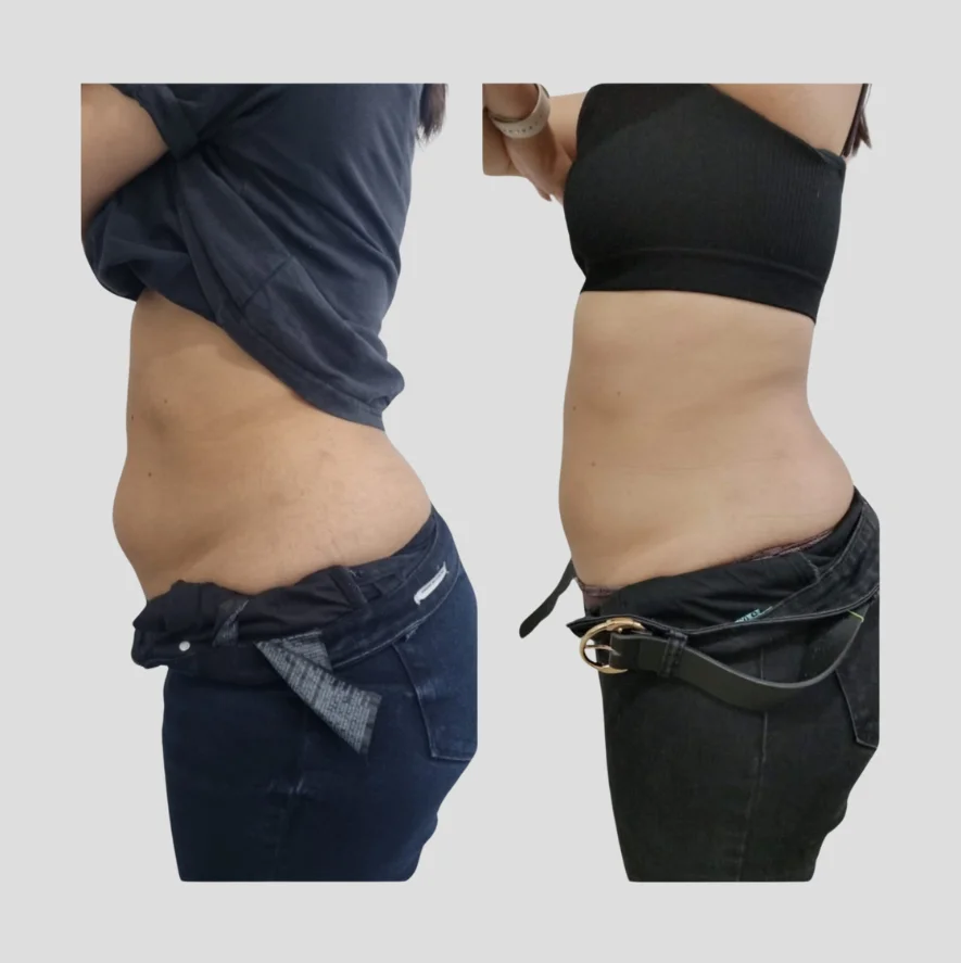 Post Operatorio Cirugía Plástica