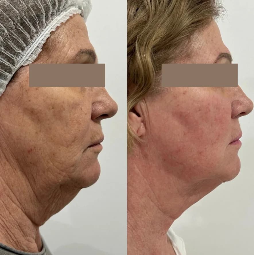 HIFU Corporal y Facial